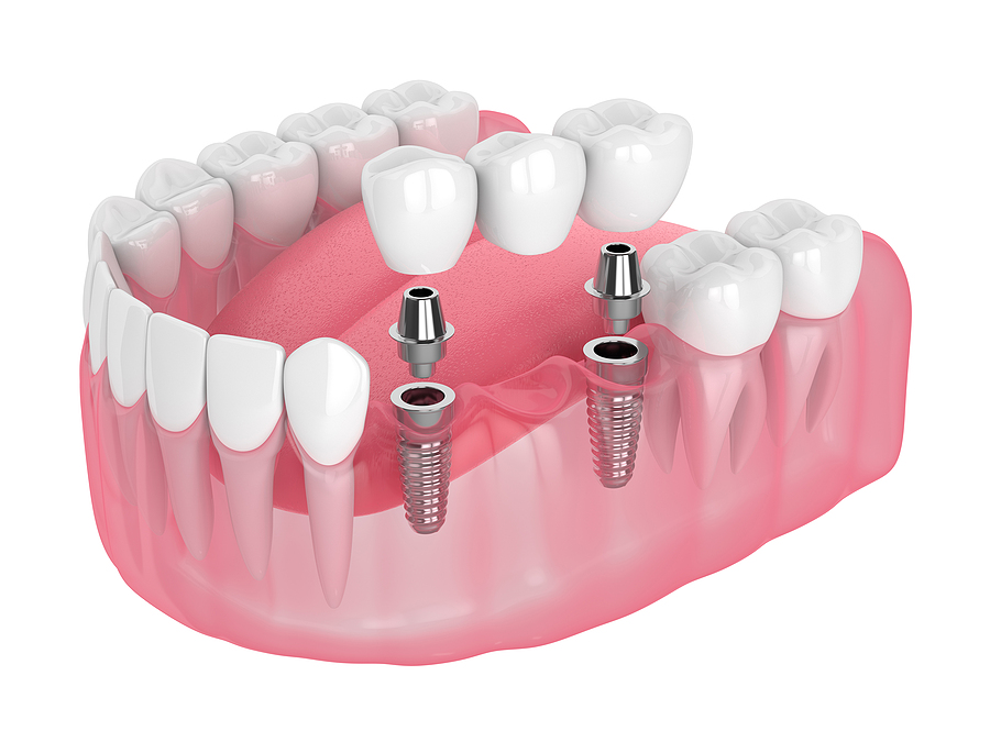 Restoring Your Smile with Dental Implant Restorations in Stamford, CT
